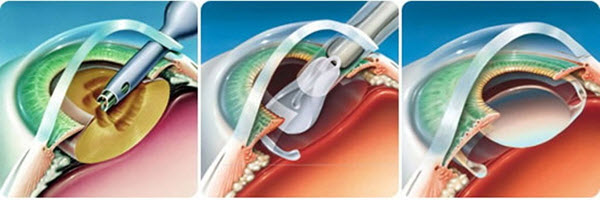 операция катаракты